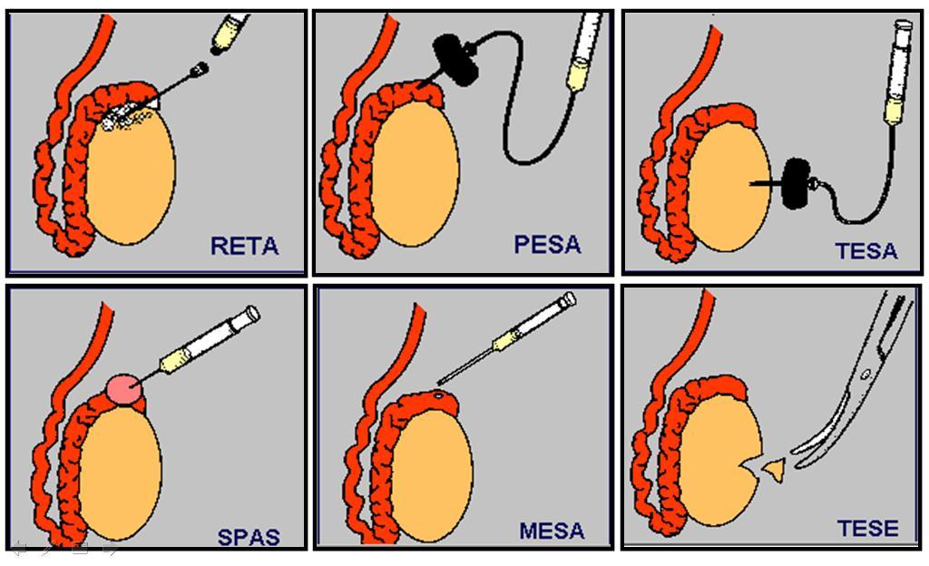 Microsurgical Sperm Aspiration TeSA, PESA, MESA, Best IVF Hospital