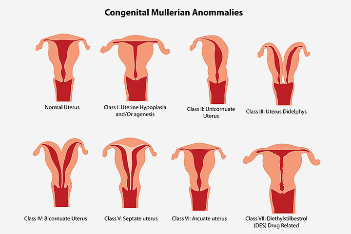 What Are The Congenital Abnormalities Of Female Reproductive System