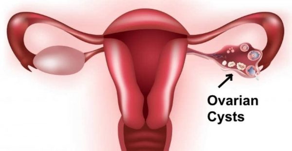 Ovarian Cysts - symptoms and treatment