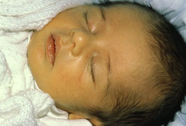 Neonatal or Newborn Jaundice  Symptoms, Causes, Risks and Treatment Options