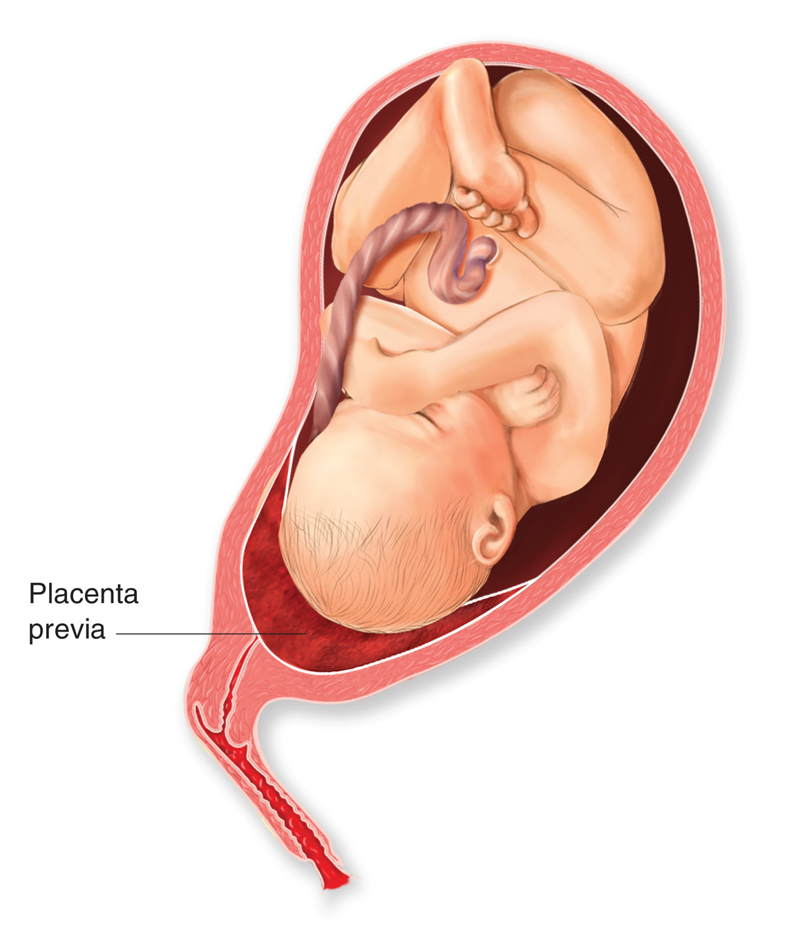 Is Low Placenta Dangerous During Pregnancy