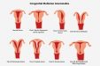 Congenital Uterine Anomalies | KJK Hospital & Fertility Research Centre ...