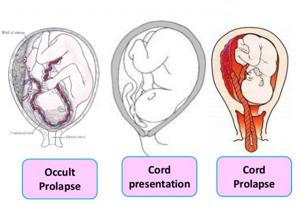 Umbilical Cord Accidents  Best Hospital in Trivandrum for High Risk  Pregnancy Care