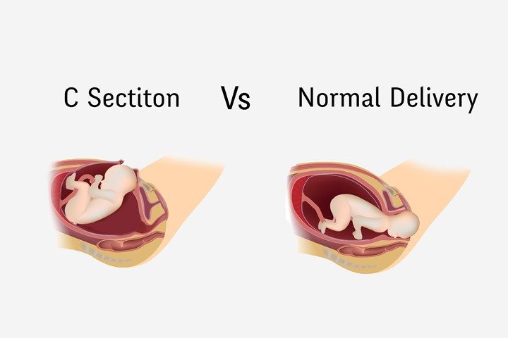 Factors determining the mode of delivery - C-section or Vaginal