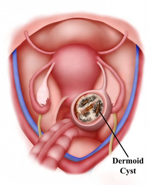 grapefruit size ovarian dermoid cyst