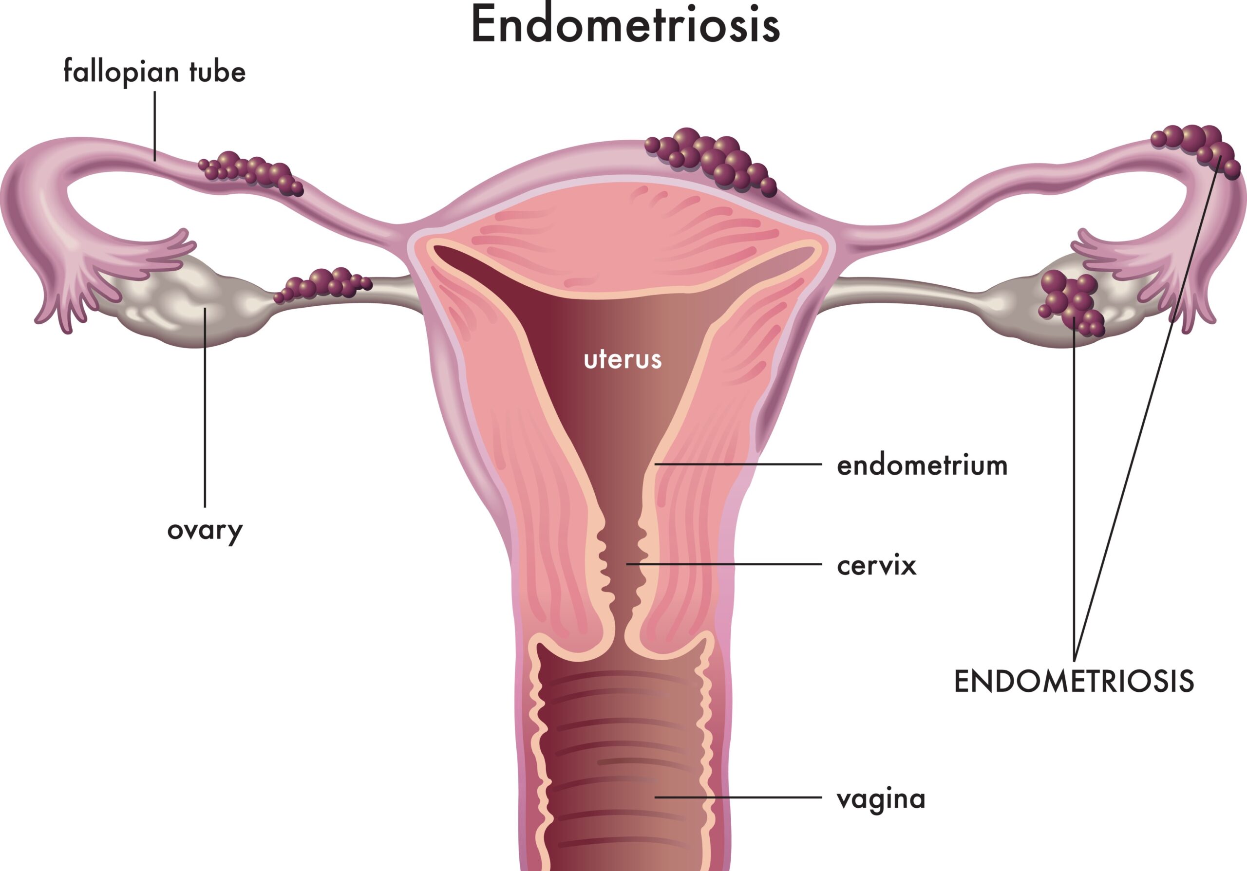 Endometriosis