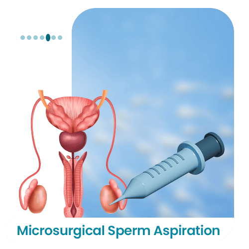 Microsurgical-Sperm-Aspiration