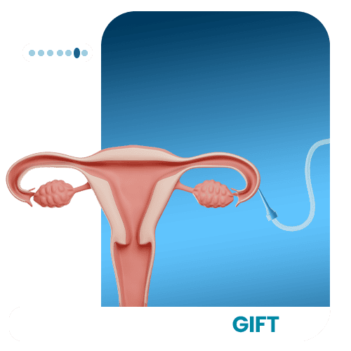 Gamete-Intrafallopian-Tube-Transfer-Gift-image